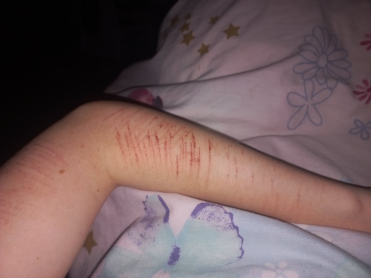 LadyBugBugsie's tweet photo. And here's my silly little arm relapsee
Unfortunately I could only do cat scratches ( ´-｀) but I'm planning on doing more soon >;3
Sooo if anyone has any suggestions on how deep to cut that would be great !! I need guidanceee https://t.co/Uqymv9CUEX