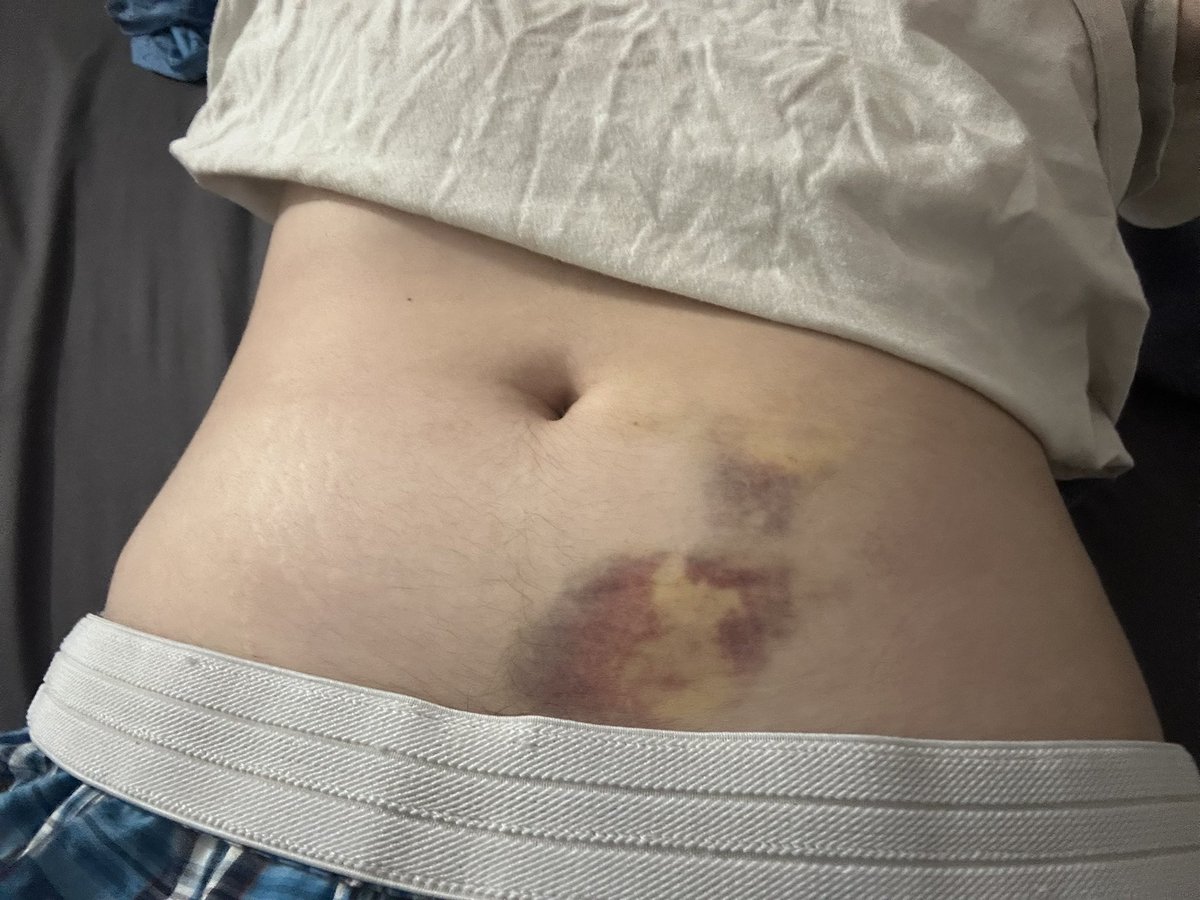 iuvoratoryyy's tweet photo. old pics from last month but bruises someone gave me on my tummy :3 https://t.co/fkbA9QGWo8