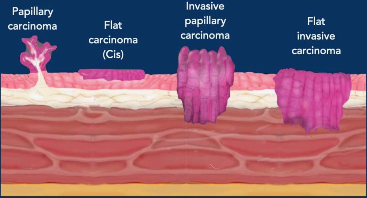 UroStuds's tweet photo. 🆕 UROLOGY UPDATE: The FDA has expanded approval of Anktiva + BCG to include BCG-unresponsive, high-grade papillary-only NMIBC. 
‼️ HIGH-YIELD: Anktiva = IL-15 receptor agonist BCG = intravesical immunotherapy
Goal: bladder preservation with high-risk disease https://t.co/ZVkkqNE960