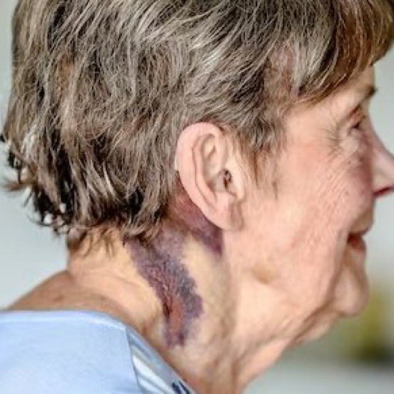 bellaislovely_'s tweet photo. 🇧🇪🧑‍🦳🧒This 80-year-old woman was sexually assaulted by a 12-year-old CHILD while on her way to do her shopping.

On Friday, April 11, 2025, in Ostend (Belgium), Esther Masschaele, 80 years old, was the victim of an ASSAULT of extreme violence while on her way to do her shopping. A boy aged only 12 or 13 threw her to the ground, VIOLENTLY slammed her head against the sidewalk, and tried to undress her.

The teenager pulled down his pants and tried to SEXUALLY ASSAULT her. The victim lost consciousness and was found with her pants around her ankles when cyclists arrived and scared off the attacker.

Deeply shocked and humiliated, Esther stated: "I was there, with my pants around my ankles, my head covered in blood, completely dazed." The attacker was taken into custody and then released UNDER CONDITIONS by the youth judge.
(RTL Info)