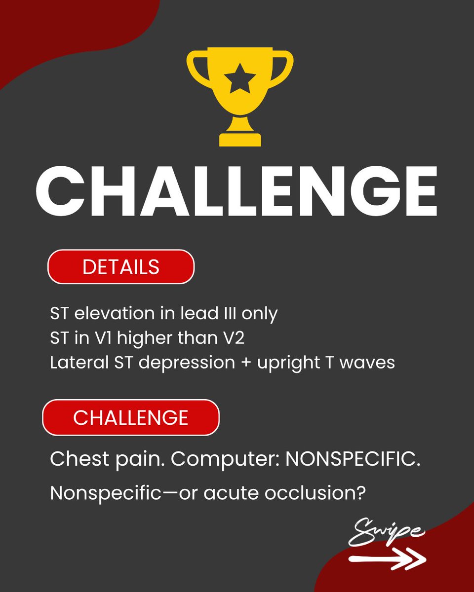 ECGWeekly's tweet photo. Chest pain. ST elevation in lead III only. ST in V1 higher than V2. Lateral ST depression with upright T waves. 🔎

Computer: nonspecific.

Nonspecific—or acute occlusion? https://t.co/fEvG2sn1t2