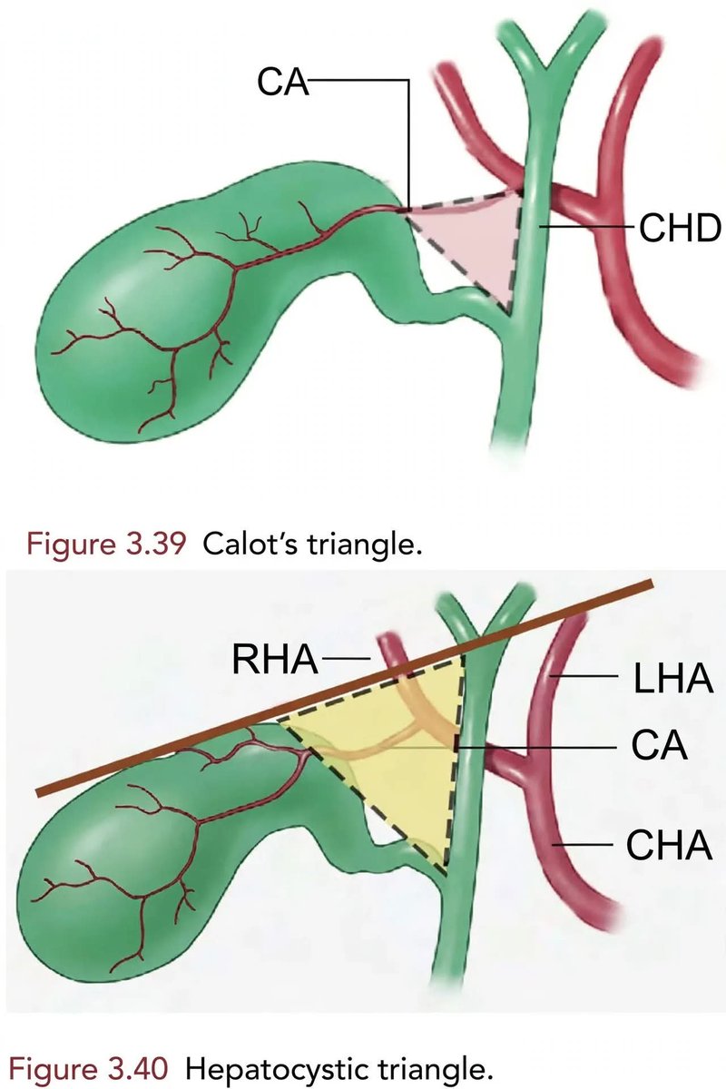 DrJStewart_GS's tweet photo. Stop calling everything "Calot's Triangle" ⚠️

There are TWO triangles, and mixing them is why bile duct injuries happen.

1. Original Calot (1891 - Open Surgery):
Borders: CHD - Cystic Duct - Cystic Artery
The artery IS the border.⤵️

 #MedTwitter #SurgTwitter #SoMe4Surgery https://t.co/YeJIHwaf1T