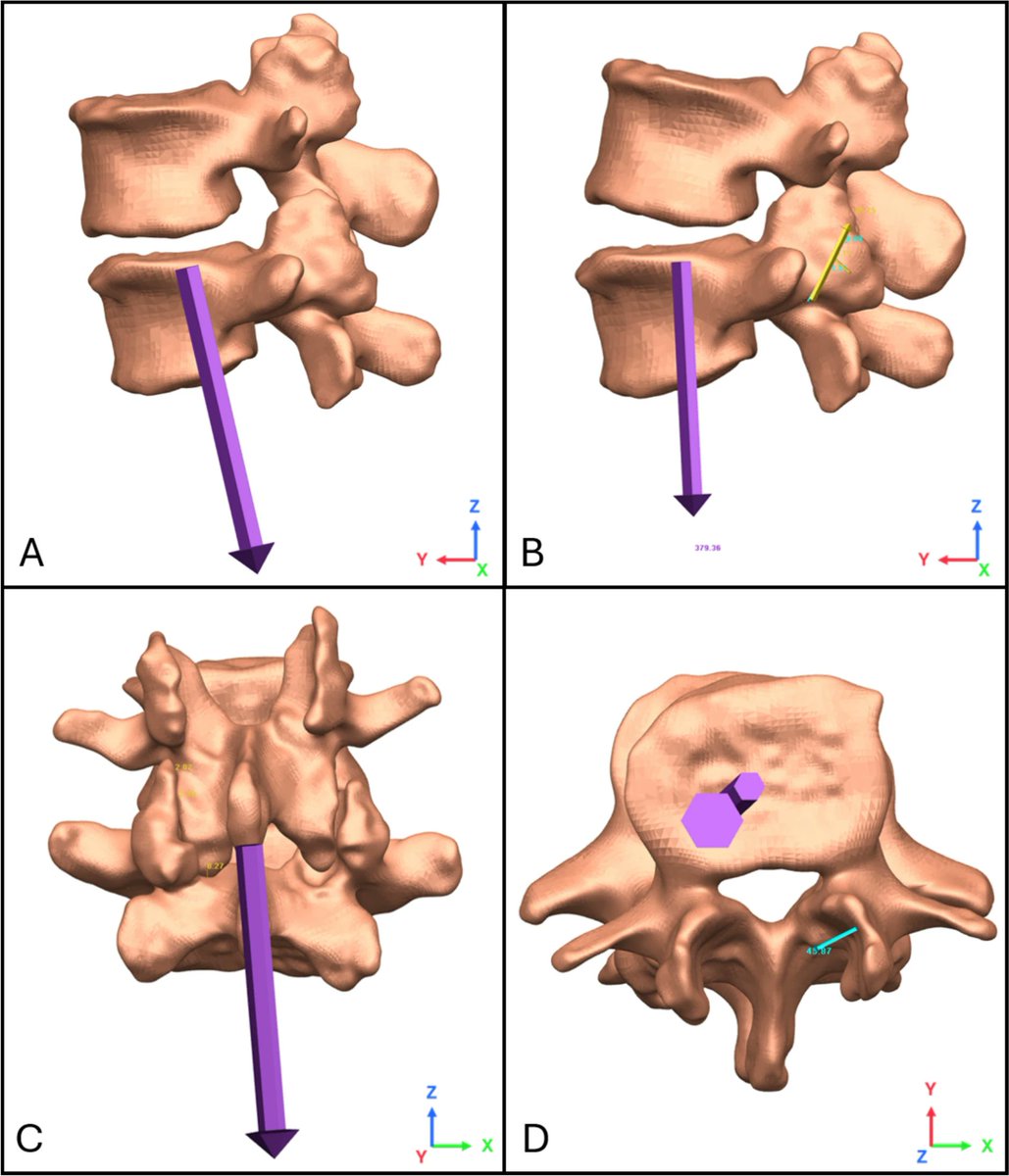 ABMEjournal's tweet photo. Low back disorders disproportionately affect women and older adults for reasons that remain poorly understood.

Researchers examined the role of spinal anatomy in these disparities by developing 360 subject-specific computational models of lumbar spine segments using CT scans from 60 adults spanning five decades of age. The models isolated the effects of vertebral geometry on how forces are distributed across intervertebral discs and facet joints under seven loading conditions. The findings revealed substantial differences associated with sex and age, including higher facet joint forces and shear loads in older adults and up to 31% greater disc loading relative to vertebral endplate area in women compared with men.

An anatomically informed understanding of spinal biomechanics could help clinicians better assess mechanical vulnerability, potentially guiding earlier interventions and more targeted strategies for reducing the risk of low back disorders.

𝗥𝗲𝗮𝗱 𝗺𝗼𝗿𝗲: https://t.co/b7832nY6j1

𝗦𝘁𝘂𝗱𝘆: Sex- and Age-Related Variation in Vertebral Geometry Influences Lumbar Spine Loading: An Image-Based Computational Modeling Study

𝗔𝘂𝘁𝗵𝗼𝗿𝘀: Gregory G. Knapik, Ehud Mendel, Eric Bourekas, and William S. Marras

@OhioState
@OhioStateMed
@Yale
@YaleMed
@YNeurosurgery

𝗦𝘂𝗯𝗺𝗶𝘁 𝘆𝗼𝘂𝗿 𝗺𝗮𝗻𝘂𝘀𝗰𝗿𝗶𝗽𝘁: https://t.co/Gyz8DNneUg