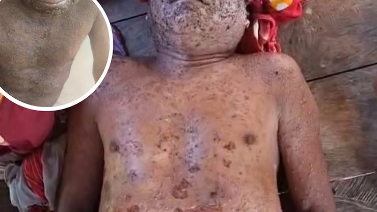 fabiolatorres's tweet photo. ¿Cuánto debe esperar una familia indígena para recibir atención médica? En Loreto, un padre #shawi murió y sus tres hijas han sido hospitalizadas con #varicela. La Coordinadora Regional de los Pueblos Indígenas denuncia que el Minsa conocía la emergencia, pero actuó tarde. 👇 https://t.co/6GAy9OiR4E