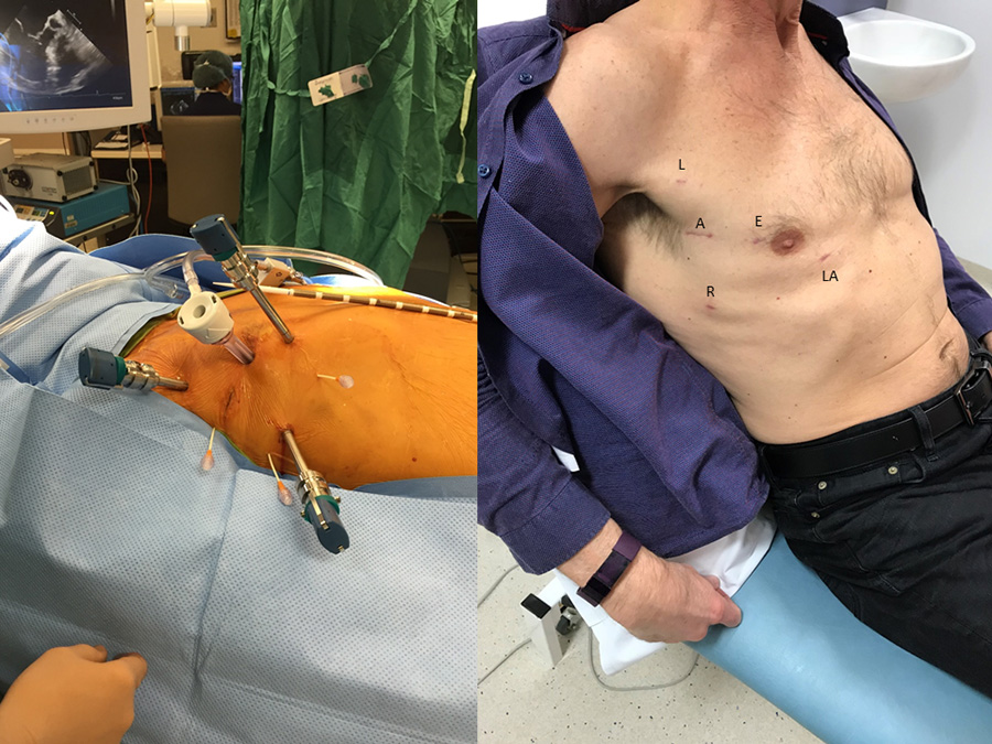 hsfeditor's tweet photo. A 68-year-old with severe degenerative mitral regurgitation (MR). Society of Thoracic Surgeons (STS) risk: low.
Would you offer:
A. Robotic mitral repair
B. Mini-thoracotomy repair
C. Full sternotomy repair

What would you choose? 👇
read:
https://t.co/0YSddIE8CZ
#CardiacSurgery https://t.co/8J8E3eJ6hP