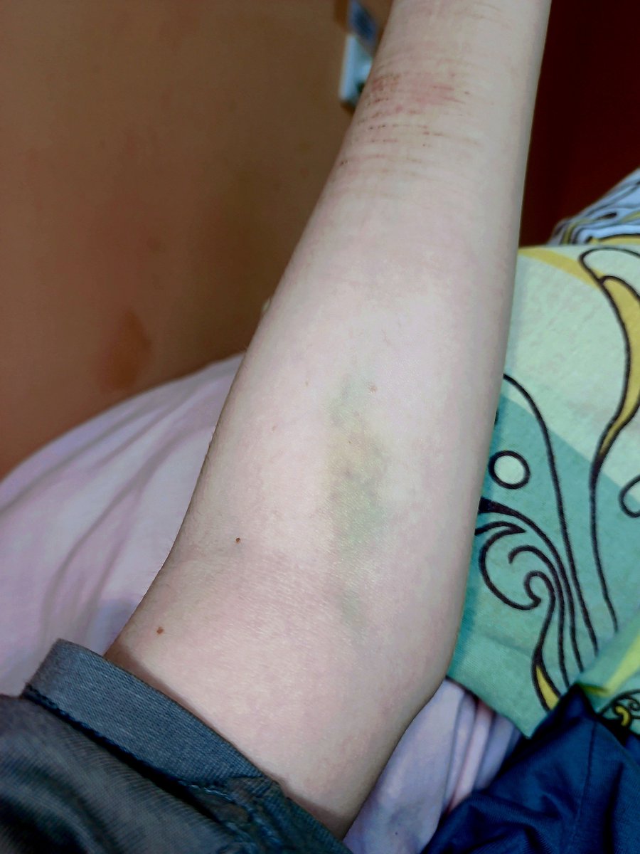 DeathKli's tweet photo. This is a small response to a relatively old post about bruises.

The bruise from the IV is mine and my former roommate's. I probably envy her. It looks beautiful.

#bruise #makeup https://t.co/Ur53mgSsEU
