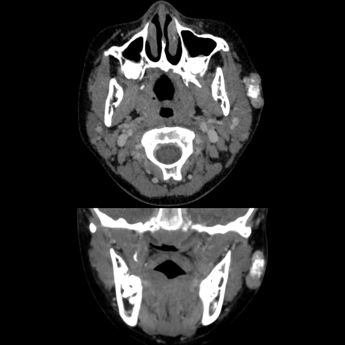 pedsimaging's tweet photo. School ager with left preauricular mass
Axial (above)+coronal (below) CT show well-circumscribed oval lesion near left ear that has calcifications within it.
#FOAMed #MedEd #FOAMRad #PedsRad #RadEd #radiology #PedSurg #SoMe4PedSurg #pediatrics #radiologia #paediatrics https://t.co/LX5Jc3ms8u