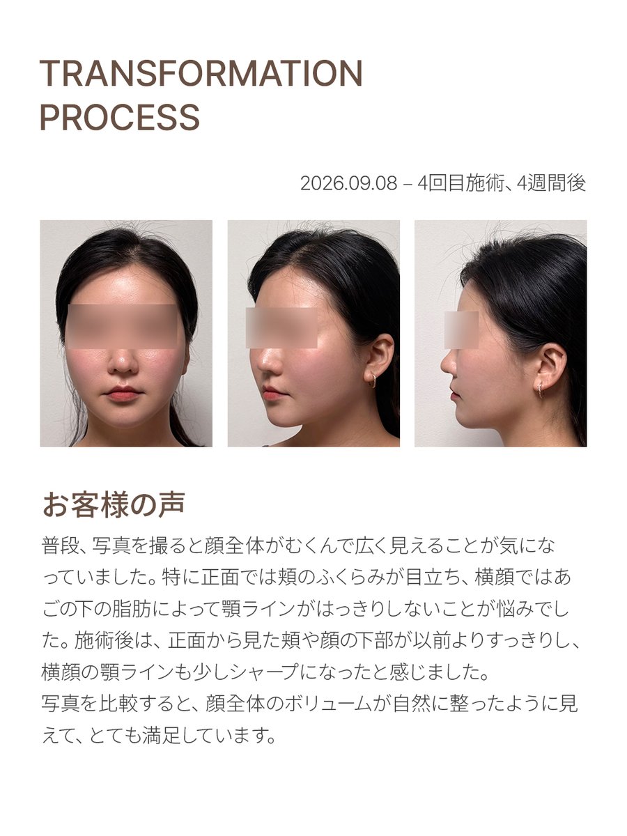 ulineclinic's tweet photo. A MAGAZINE FOR U, VOL.26

同じ顔でも、見る角度によって輪郭の印象は変わります。
正面から見ると、頬のボリュームが顔の横幅を強調することがあり、横から見ると、
あご下の脂肪がフェイスラインをぼやけさせることがあります。

Vカット注射は、こうした部位ごとの脂肪分布を考慮し、
自然で立体感のあるフェイスラインづくりに注力します。
今回のマガジンでは、正面と側面で異なる顔の輪郭の特徴と、
脂肪分布を踏まえたアプローチについて取り上げました。

➡ いますぐ相談する：https://t.co/HfSfxBaIFu
➡ マガジン：https://t.co/d42hqpQQuH
➡ お問い合わせ電話：☎+82-2-516-7588☎

#カット注射 はユーラインクリニックでのみ施術可能ですので、なりすましクリニックからの被害には十分ご注意ください :)

#ユーラインクリニック #ユーラインマガジン #10月マガジン #マガジン #美容マガジン #顔の脂肪 #Vライン #二重あご #輪郭ケア #フェイスライン #ディープチーク #ユーラインカット注射 #Vカット注射 #分析と測定 #測定に基づくケア