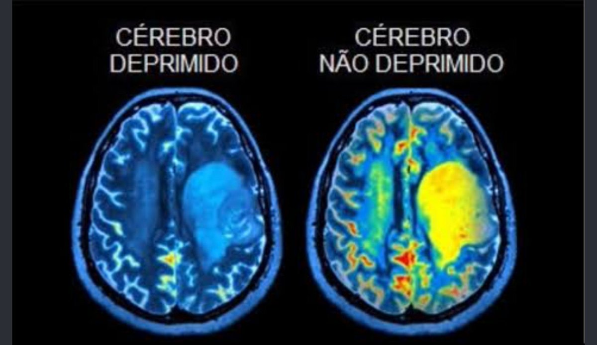 Lviact1's tweet photo. Ser neurodivergente é engraçado,  por que como assim o meu cérebro não é fisicamente igual o das outras pessoas??? https://t.co/pp1KLrS9dx