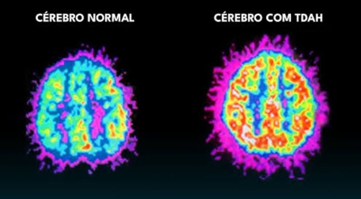 Lviact1's tweet photo. Ser neurodivergente é engraçado,  por que como assim o meu cérebro não é fisicamente igual o das outras pessoas??? https://t.co/pp1KLrS9dx