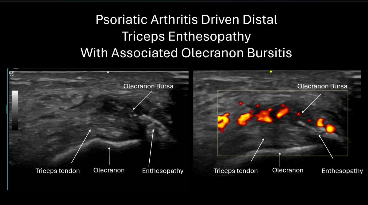 MillwardLuke's tweet photo. This ultrasound image shows a nice example of psoriatic arthritis-driven distal triceps enthesopathy, with associated olecranon bursitis.
#Rheumatology #MusculoskeletalUltrasound #PsoriaticArthritis #Enthesitis #Sonography #Bursitis #ImagingInRheumatology https://t.co/HtLAMuu1Cn