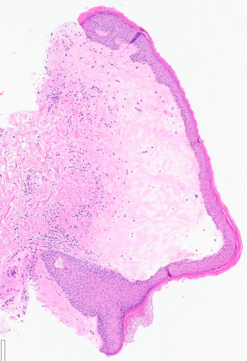 ZemplenPataki's tweet photo. Vulva. What is your diagnosis? 🔎

Poll below 🗳️👇

#PathPuzzle 🕵️‍♂️
@UMichPath #Pathology #PathX #PathTwitter https://t.co/RE1aSbJRRY