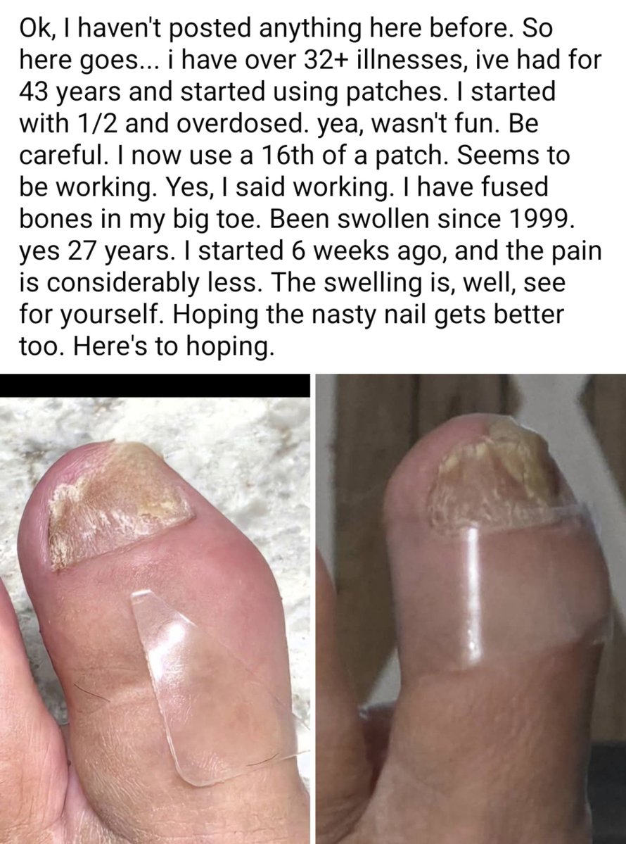 Canal1point5's tweet photo. Interesting post. Even after decades we can find things that help.
Don't give up!
Anyone else of photos of before and after related to reduced inflammation?
#LongCovid #MECFS
@TheNicotineTest https://t.co/mEu35czcui