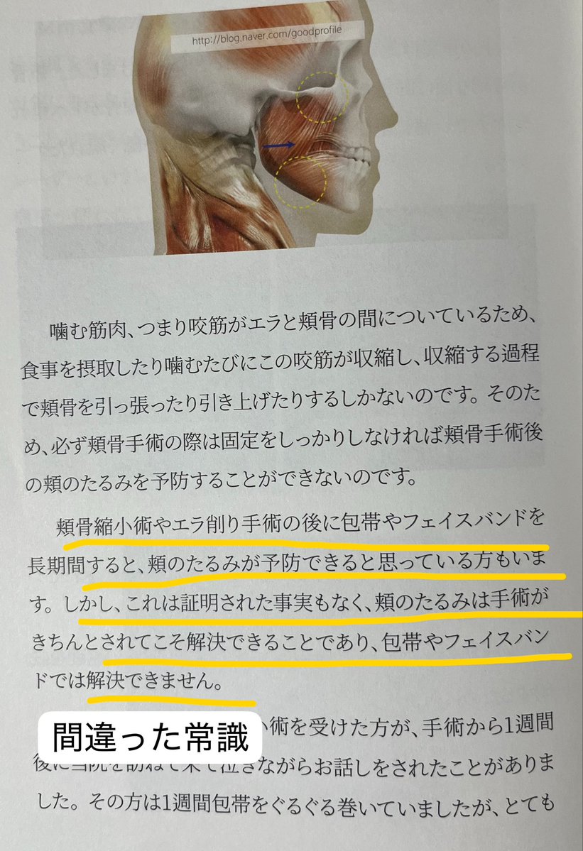 3b2zg's tweet photo. ということでルフォー・SSRO・頬骨削り・エラ削りの手術後に老け顔になる原因やアフターケアで気を付けておいてほしい点について記述がある論文漁ってきました！！！

これから輪郭骨切りを考えてる人は下手な医者で弛んでしまう前にご一読を⚠️ https://t.co/kNRRrXlCFa