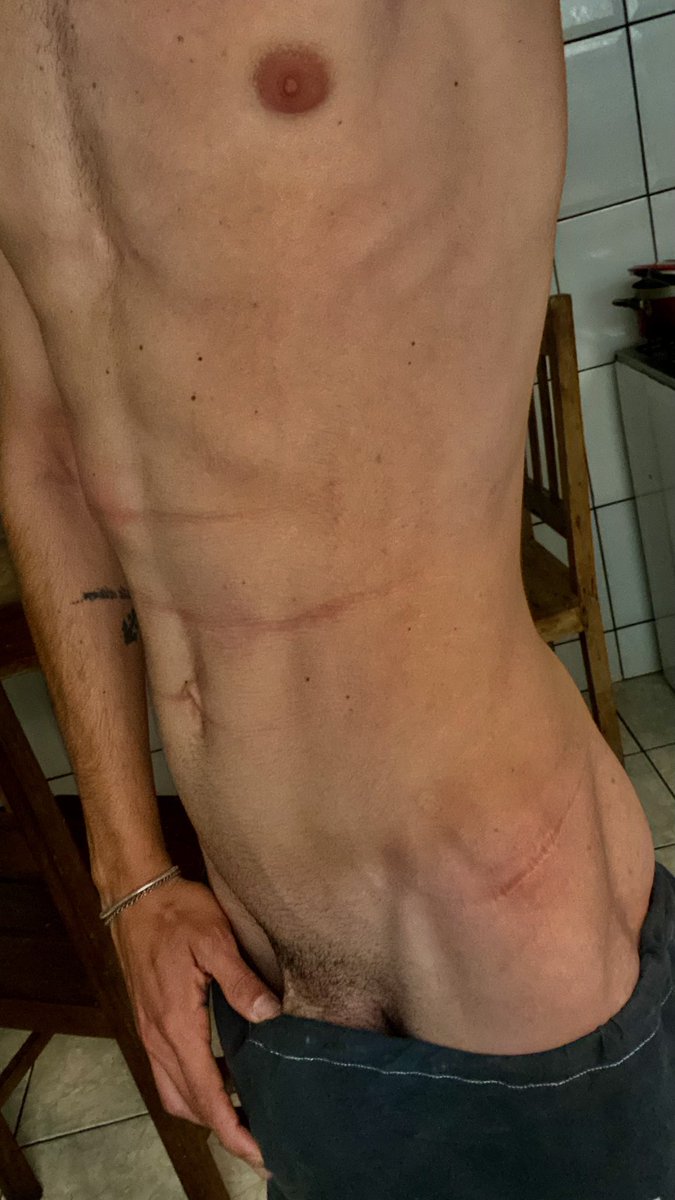 Allan_Britto_'s tweet photo. Ser branquinho, fica marcado por qual quer coisa 🙈 https://t.co/4bTJ6ApUq6