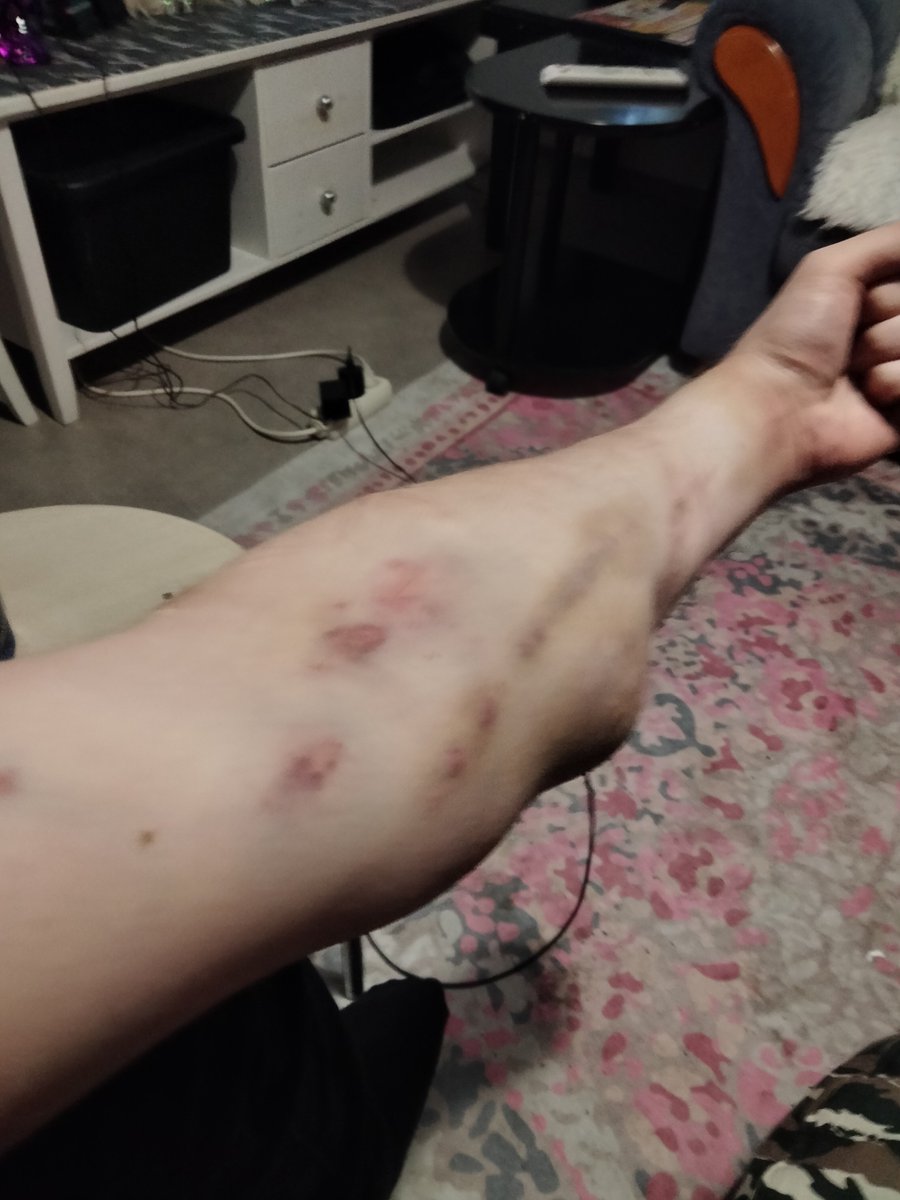 ParanoidFoxyBoy's tweet photo. The moral of the story: don’t inject yourself while drunk as fuck... my arm fucking hurts...fuck my life...😩
#drugs #drugstwt #amphetamine #failedinjection #amputationaheadlol https://t.co/gY3Eh6IPnj