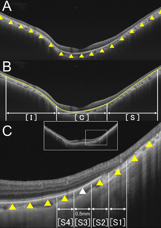 ARVOiovs's tweet photo. Shinji Ueno et al. from Hirosaki University Graduate School of Medicine find that retinal flattening associated with photoreceptor degeneration leads to the formation of staphyloma-like morphology in retinitis pigmentosa. 
https://t.co/D9OH15issK https://t.co/V2eqv8APIc