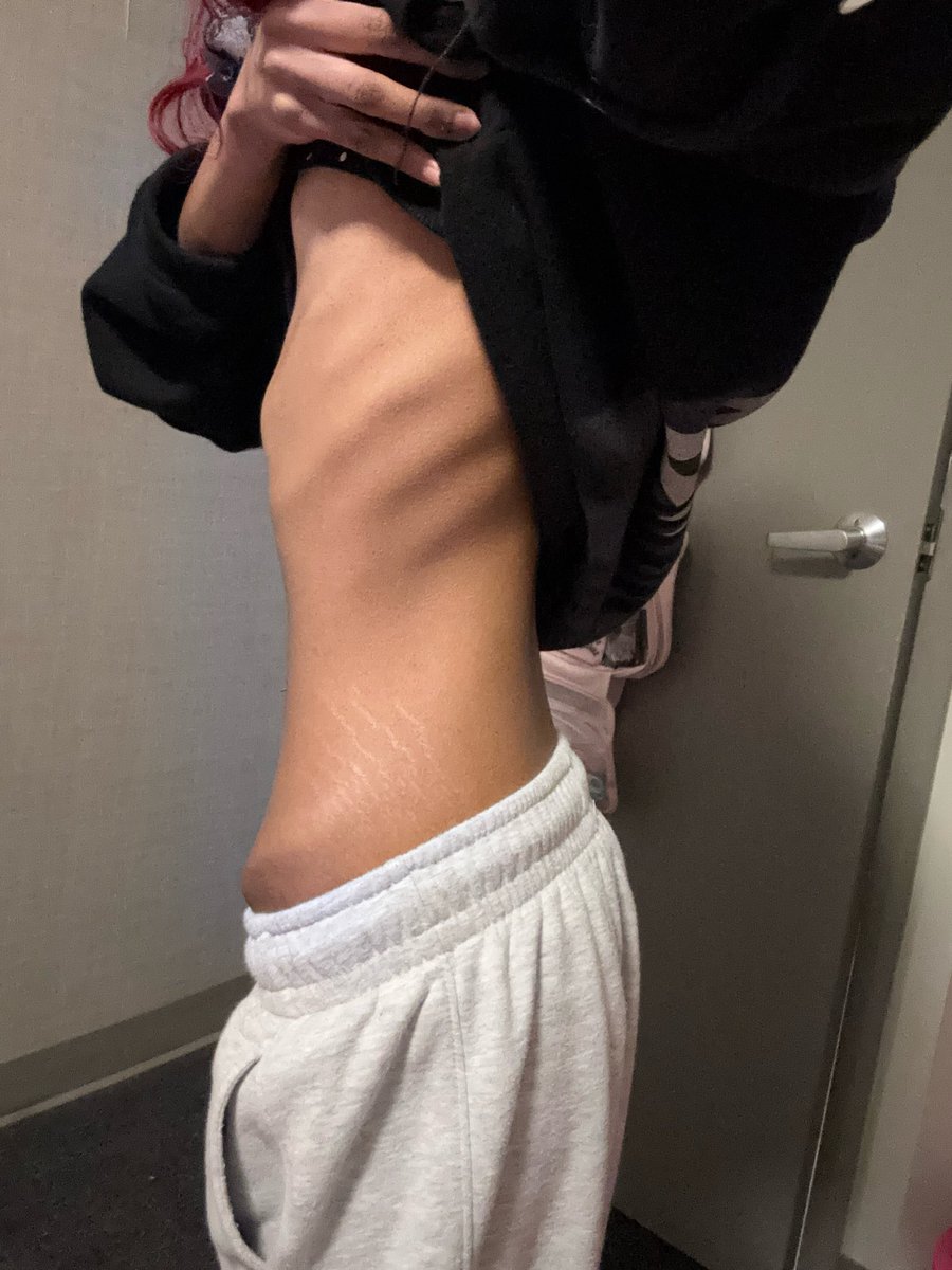 zerocalcookies's tweet photo. stomsch full of diet soda rn but my ribs are gwtting visible again a little bit i think https://t.co/H3ZV3JTF6X