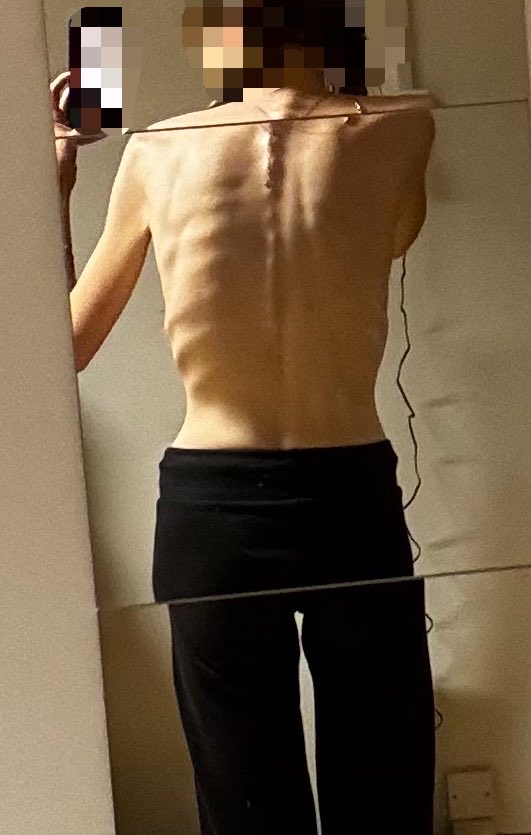 n4lyxie's tweet photo. #bodycheck idk if i wanna chase bmi 13 (since i’m so close) or recover. what even is this way of living? there is a war inside my head. i don’t even have a gw anymore i lowered it so many times already i’m just losing now only to keep some purpose in my life https://t.co/3tVojl9Ex6