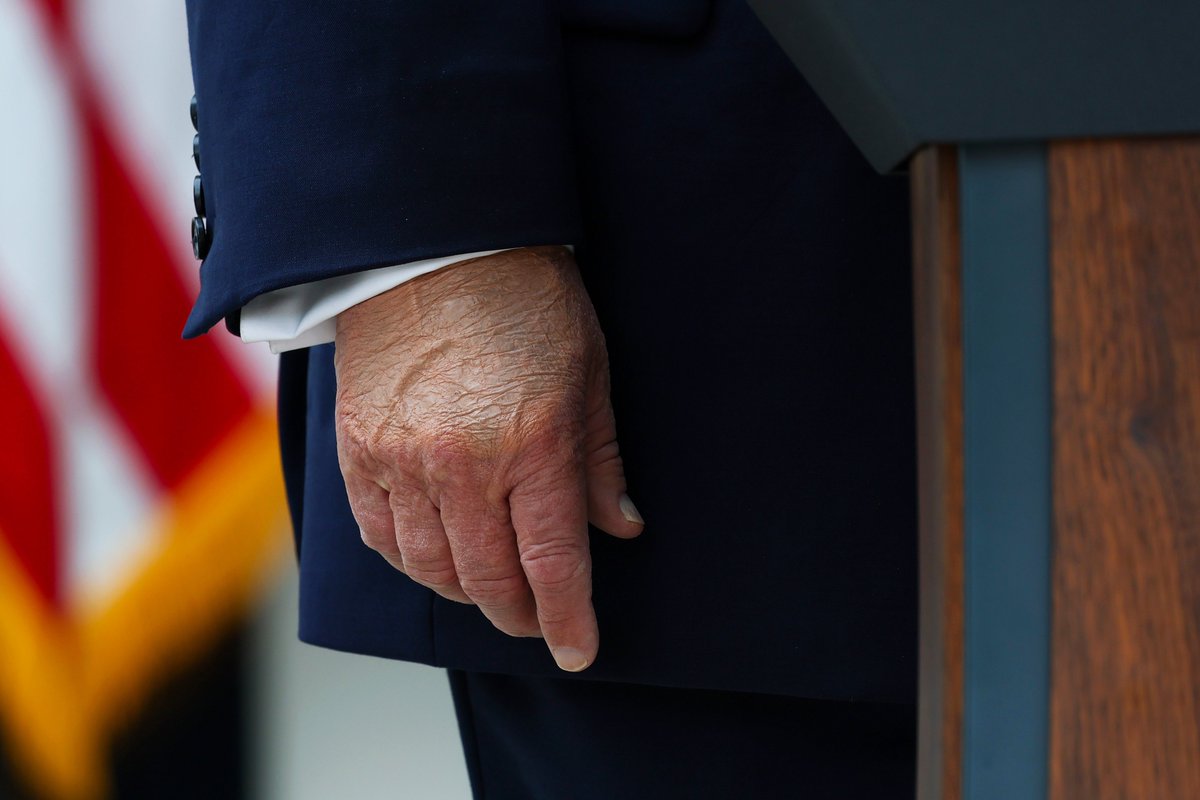 atrupar's tweet photo. new pic of Trump's rotted hand just dropped. this is from today

(Kevin Dietsch/Getty) https://t.co/bCdkVQVCIn