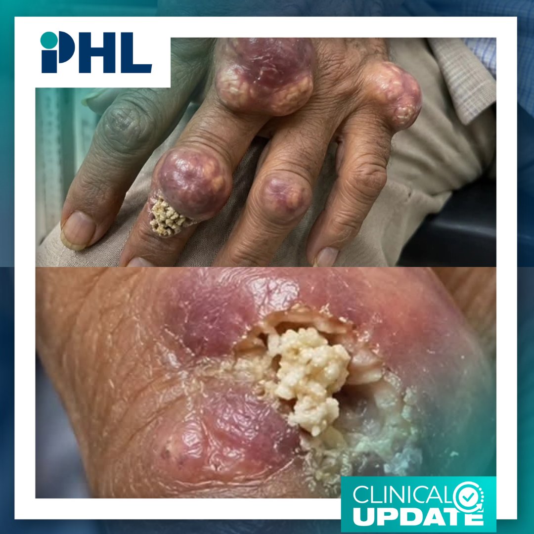 PH_Latam's tweet photo. ✅ Clinical Update | ¿Cuál podría ser el diagnóstico final? ⏩ https://t.co/qHZR3onVYE
#PHL #Reumatología https://t.co/FNKlHFUCno
