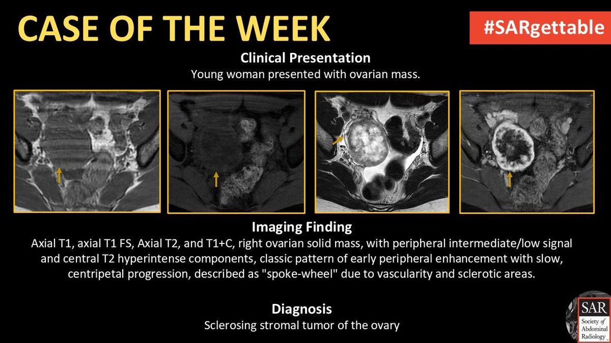 SocietyAbdRad's tweet photo. #SARGettable Case diagnosis revealed!

Thanks for playing! 

#SAR #Radiology https://t.co/BWveZOmRmw