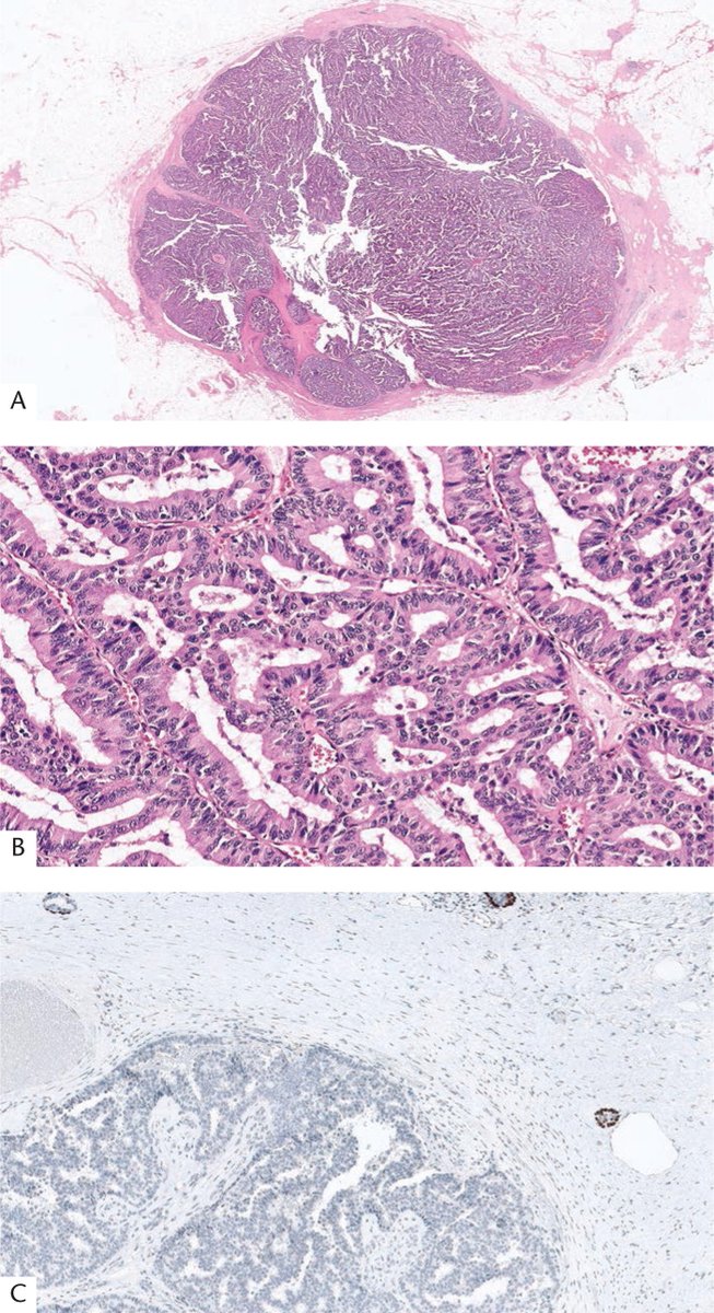 ARP_Press's tweet photo. October is Breast Cancer Awareness Month, inspiring our case of the month:

A 70yoW presents with a single, lobulated, retroareolar breast mass. A-B H&amp;Es, C P63, D SMM-HC

See the poll below - what's your diagnosis? Answer and discussion out in a couple of days!
#BreastPath https://t.co/UehCXcnoSy