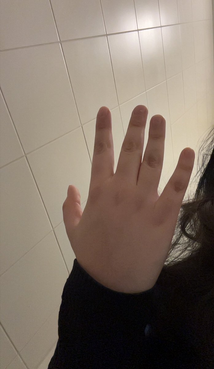 Zumi165481's tweet photo. before vs after 🤡 #meatgloves #edtwt #ana #wl https://t.co/mVQmNBQqlO