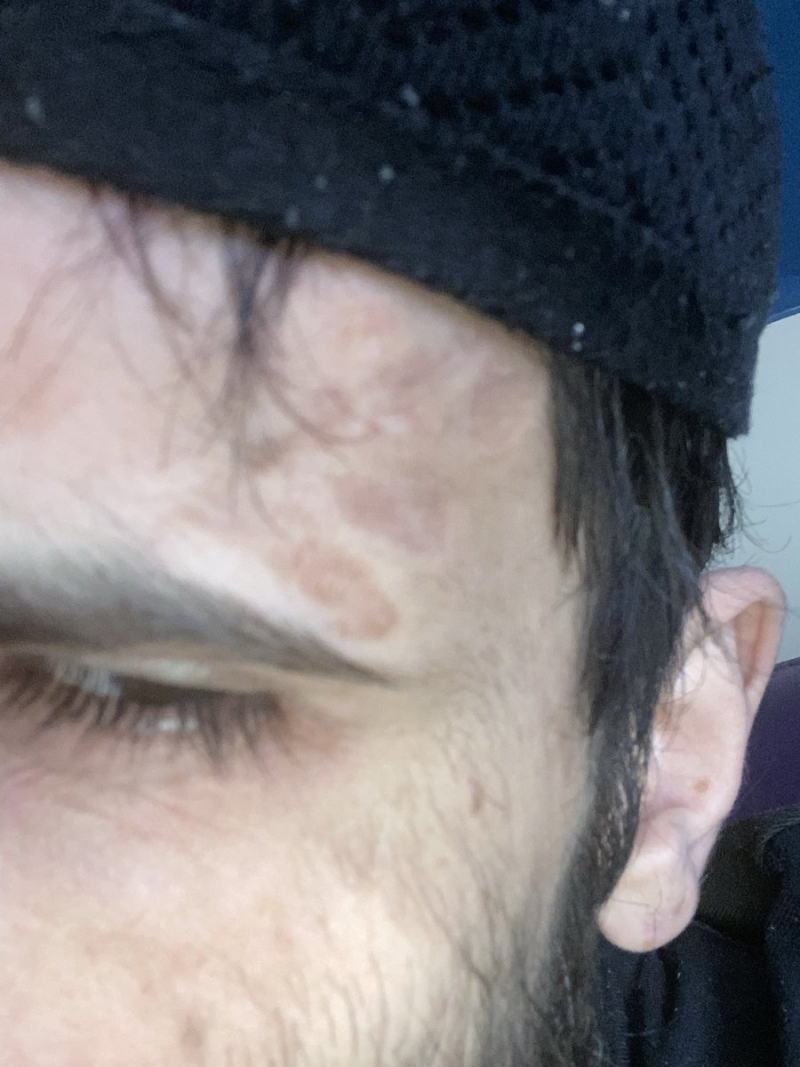 ProphetMohammex's tweet photo. The prophets marks one to the left temple and one to the right i have been struck in the country the are burning my hair https://t.co/ng3TIlEUTq