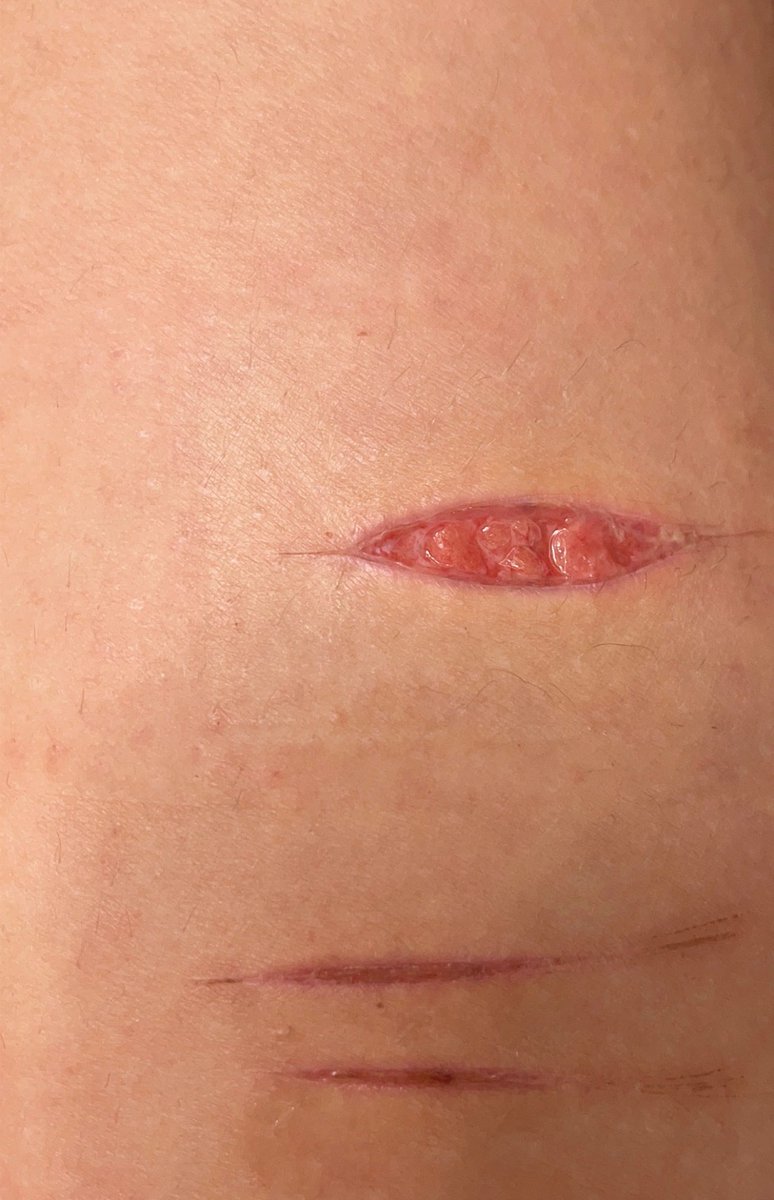 monsterjjune's tweet photo. I put a band aid on my bean from like last Friday and it’s been a week now and when I took it off last night the cut looks like this is it infected?

It  kinda had LIEK white sticky stuff only a little Ont he band aid and as I took it off #shrtwt
#shedtwt #sfxmakeupb https://t.co/TGkT62KEZ0