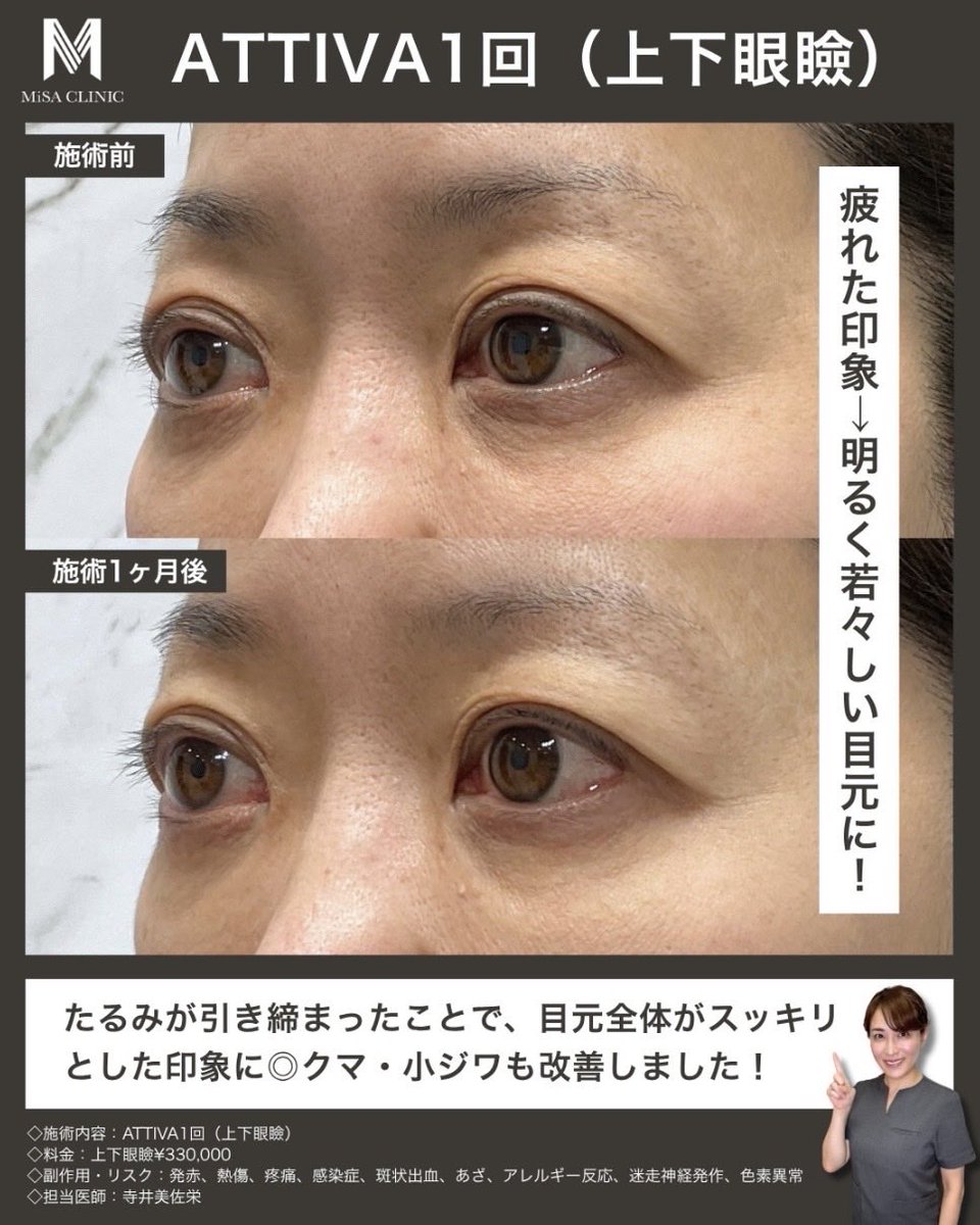 MiSA_Clinic's tweet photo. 切らずに若々しい目元へ👀

上まぶたのたるみや目元の重さ、気になっていませんか？

そんなお悩みにおすすめなのが切らないたるみ治療ATTIVAです💡

今回の症例では、
✔ 上まぶたの皮膚のたるみ
✔ まぶたの重さによる目の開きにくさ
といったお悩みにアプローチ！ https://t.co/r8XIqtdfNP