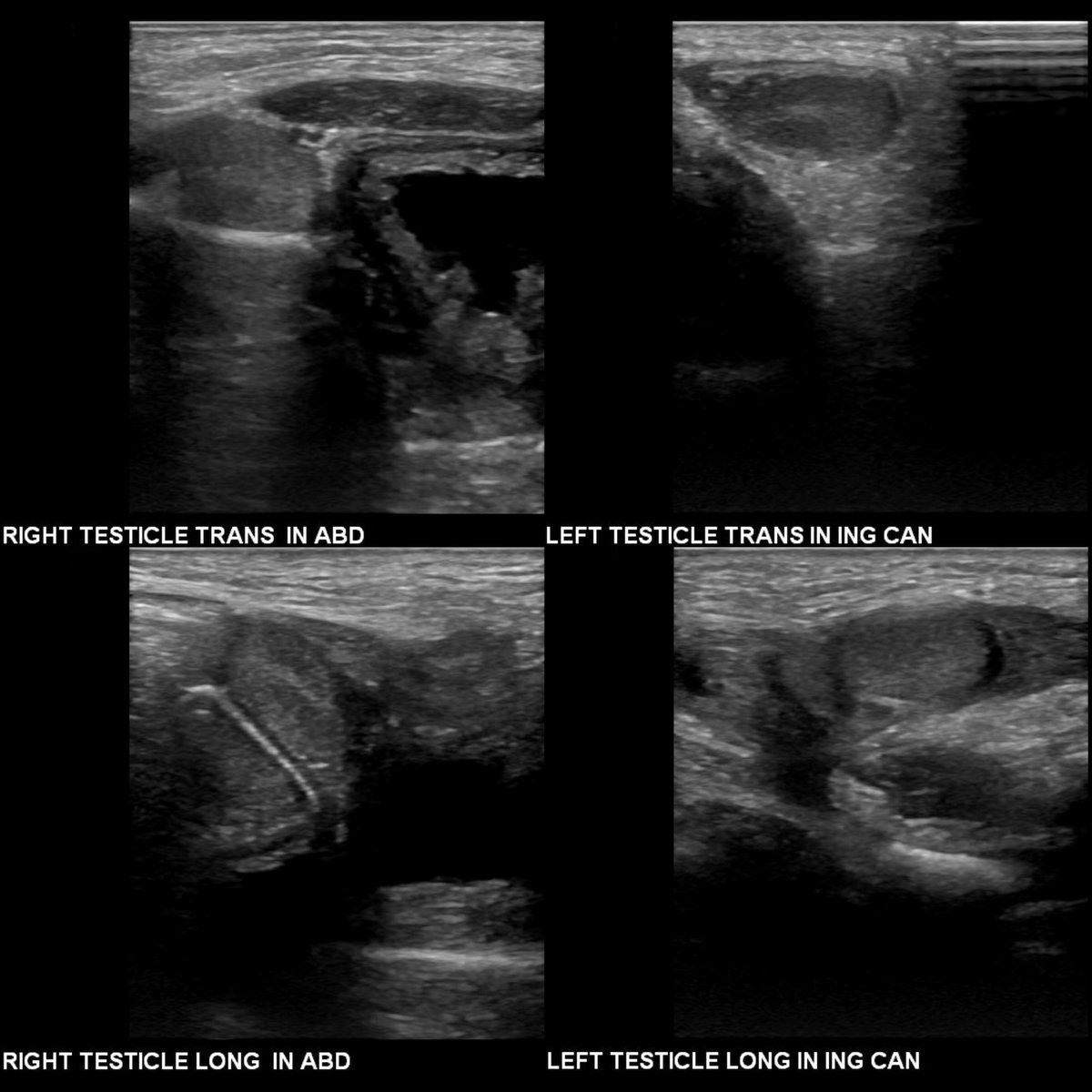 pedsimaging's tweet photo. Newborn with bilateral unpalpable testicles

Transverse(above left)+sagittal(below left) US of pelvis show right testicle to lie lateral to superior aspect of bladder

#FOAMed #MedEd #FOAMRad #PedsRad #radiology #pediatrics #radiologia #NICU #Neonatology #Ultrasound #paediatrics https://t.co/fFif3hCUhJ