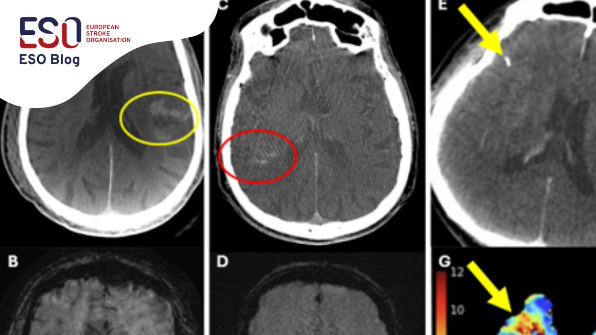 ESOstroke's tweet photo. 🧠 New #ESOBlog: Is angiography enough after thrombectomy?

Petra Cimflova, Lorenz Grunder &amp; @CheesemakerMD explore how flat-panel imaging could reveal residual occlusions, tissue injury and hypoperfusion.

🔗 https://t.co/Aca3Mt0gbA

#Stroke https://t.co/mVP864Mw6G
