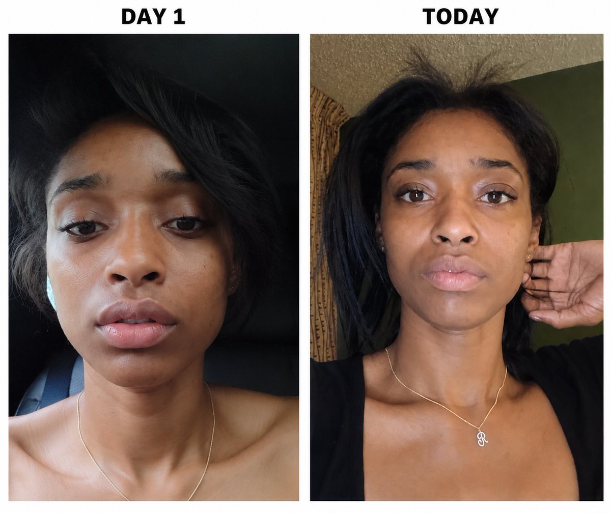 ThisRockyj's tweet photo. @Evil__Huncho Botox results from day 1 to today which is 11 day difference https://t.co/5T1zpVktjL