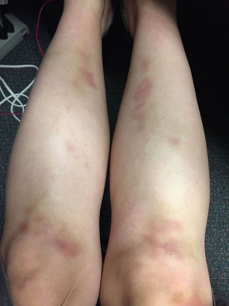 bushhafikk's tweet photo. I love when daddy leave his marks to show the world who owns me… 
#daddykink #daddysbiggirl
#babygirl #cnc #abusekink #sizekink #ageplay #biglittlegirl #bruise #bdsm #nsfw https://t.co/5yRs65sTO4