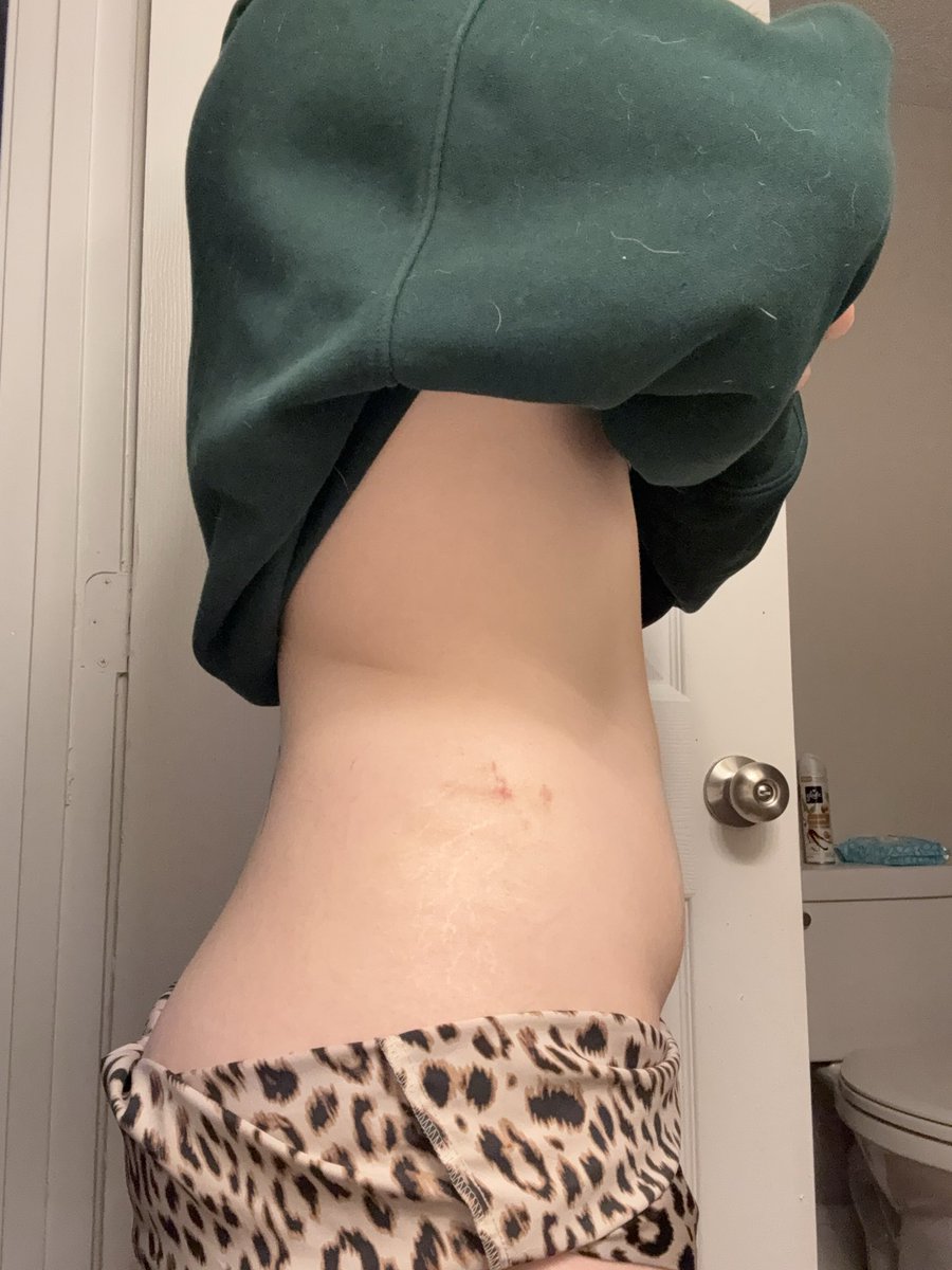 Lizanna_skinny's tweet photo. 2.5 month difference this is so crazy
#edrtwt #ricecakestwt #thinspo #comparespo #bodycheck #wl

                  ⋆. ⊹˙۰₊˙⋆✶⋆˙₊۰˙⊹ .⋆ https://t.co/pyaz0fZvpJ