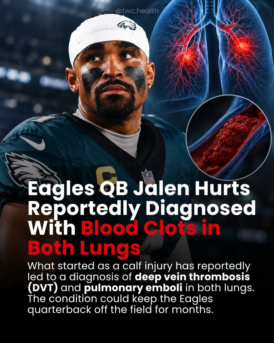 twc_health's tweet photo. Philadelphia Eagles quarterback Jalen Hurts is reportedly out for the season and being treated for blood clots in both lungs, following an injury that initially appeared to be limited to his calf.

Hurts was struck in the leg during an October 4 game against the Los Angeles Rams. An ultrasound several days later reportedly identified a superficial blood clot, and he was initially cleared to play.

But follow-up testing raised concerns, and reports published October 19 indicate that Hurts has since been diagnosed with deep vein thrombosis (DVT) and bilateral pulmonary emboli.

DVT occurs when a clot forms in a deep vein, usually in the leg. If part of that clot breaks loose and travels to the lungs, it can cause a pulmonary embolism, a potentially life-threatening blockage.

Symptoms of a pulmonary embolism can include sudden shortness of breath, chest pain, rapid heartbeat, and coughing up blood. Anyone experiencing these symptoms should seek emergency medical care.

Hurts is reportedly stable and expected to recover, although treatment may keep him out of football for several months.