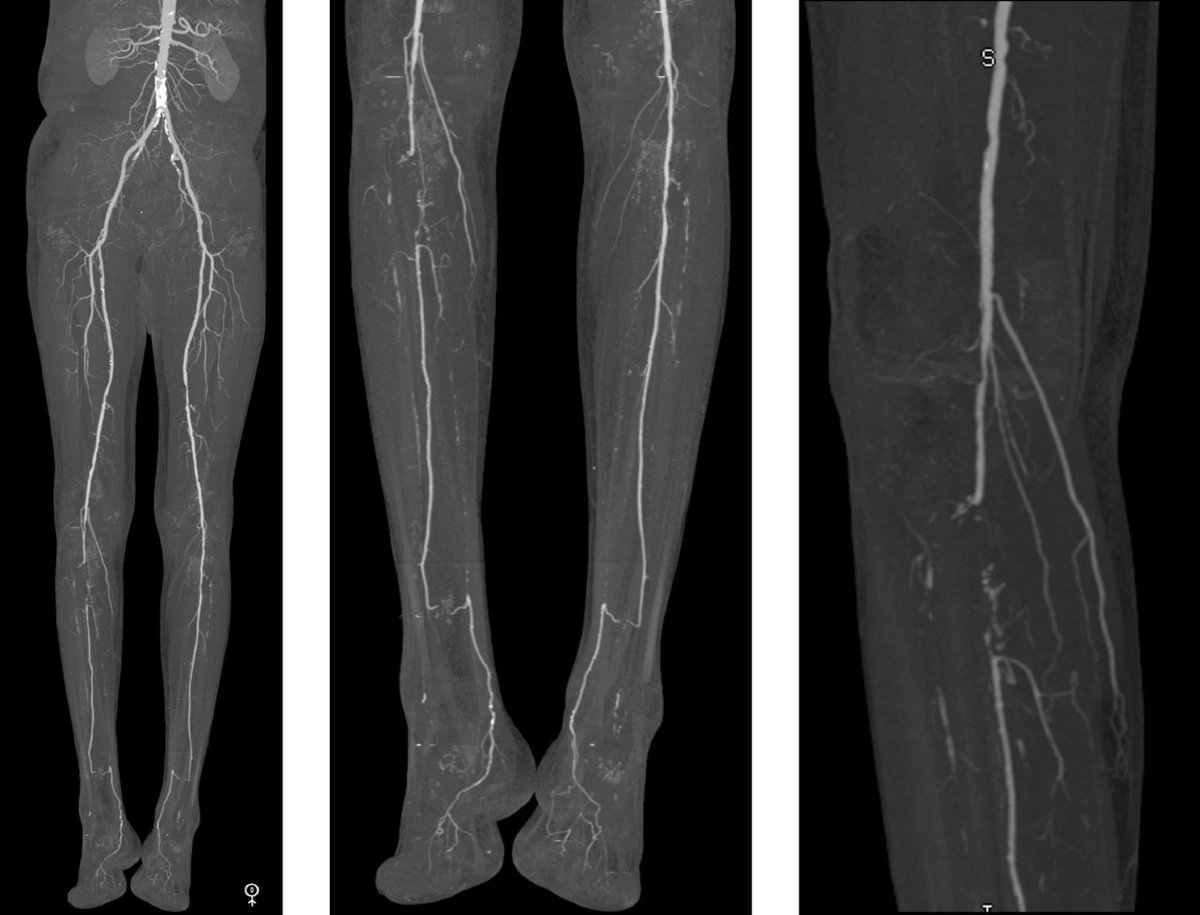 Kennyperez's tweet photo. GuideAI Health will study AI-assisted leg CT angiography for plaque burden at Colorado's Boone Heart Institute, plus a 3-month pilot of its Elevate vascular AI platform. Its occlusion-triage module is FDA 510(k)-cleared; the plaque tool is investigational, per the company. https://t.co/IM2E2BfVdH
