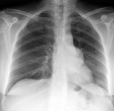 RadMasterclass's tweet photo. CHEST X-RAY 34: Cough and short of breath. Where in the chest is the abnormality? Is it anterior or posterior and how can you tell?
Answer https://t.co/b1bsYJgvO1 https://t.co/uvUpgNT4Eb