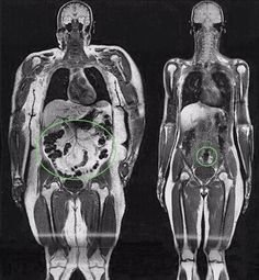bingebeetle's tweet photo. @username2008717 i like to remind myself not only how fat distributes throughout the body but how large the stomach expands. images like this are really fun for that https://t.co/Kr8Ko2gbYM