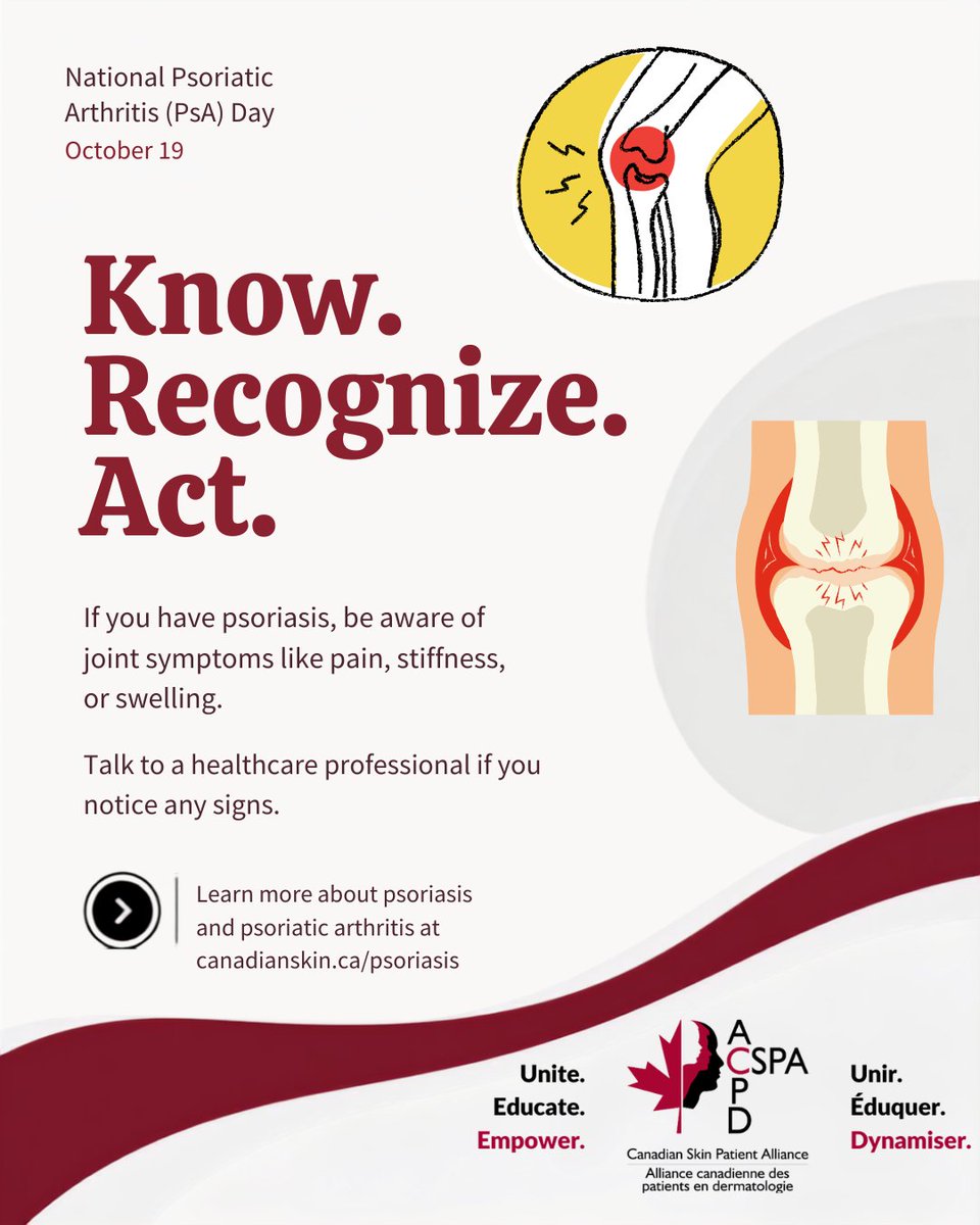 CanadianSkin's tweet photo. October 19 is National Psoriatic Arthritis Day, an inflammatory form of arthritis that can cause joint pain &amp; swelling, &amp; it can affect people living with psoriasis.  About 1/ 3 people with psoriasis will develop psoriatic arthritis. Learn more at https://t.co/3EMRNLo1Vm. https://t.co/BnuYyi3hdu