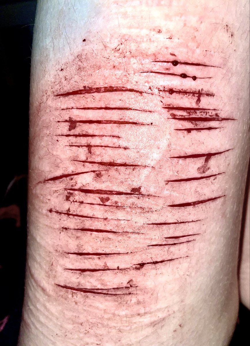 c0tardsS0luti0n's tweet photo. Small relapse after a few months
Mostly styros
#shtwt #shedtwt #slittwt https://t.co/XIFIDnBDXQ