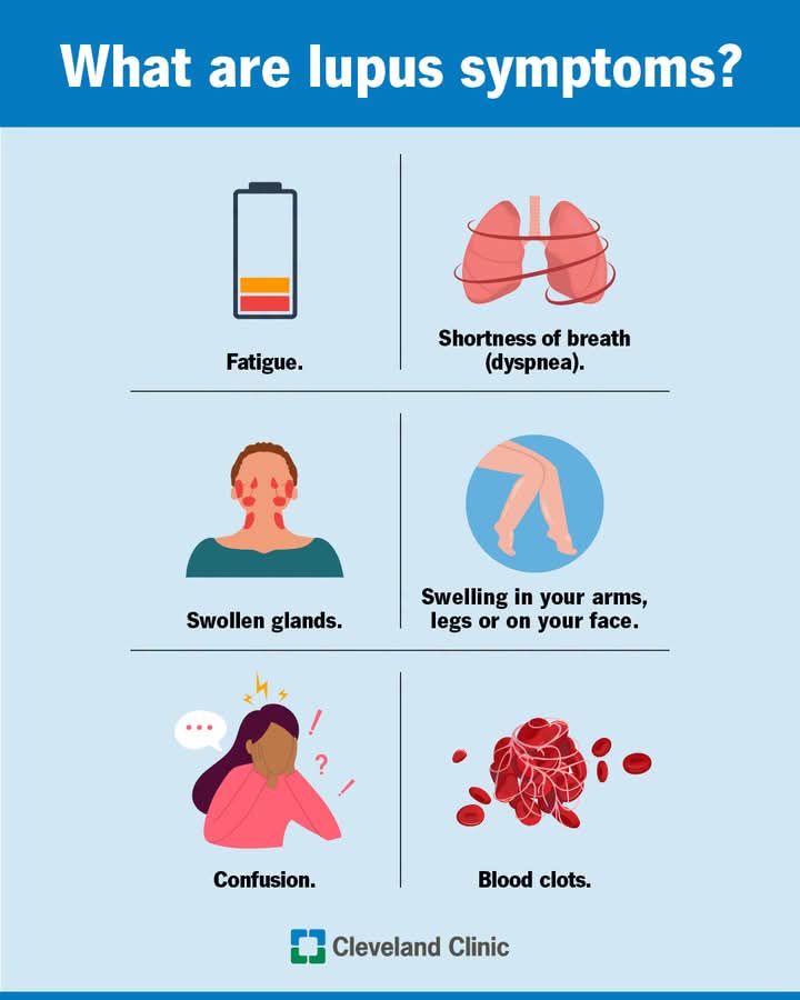 Faisal67450's tweet photo. Lupus is an autoimmune disease that makes your immune system damage organs and tissue throughout your body. It causes inflammation that can affect your skin, joints, blood and organs like your kidneys, lungs and heart. https://t.co/1FwAXy6aJ9