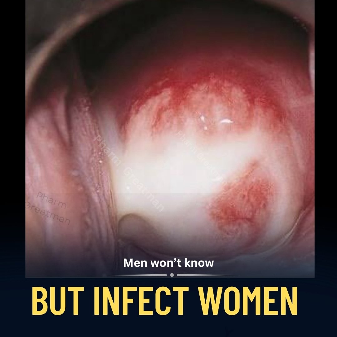 OGreat6's tweet photo. Men, you can have an infection without itching, pain, discharge, or any other warning sign … and still pass it to a woman during s3x.

The 7 infections men can have without knowing.

1. Chlamydia https://t.co/Bj3hDnhqxD