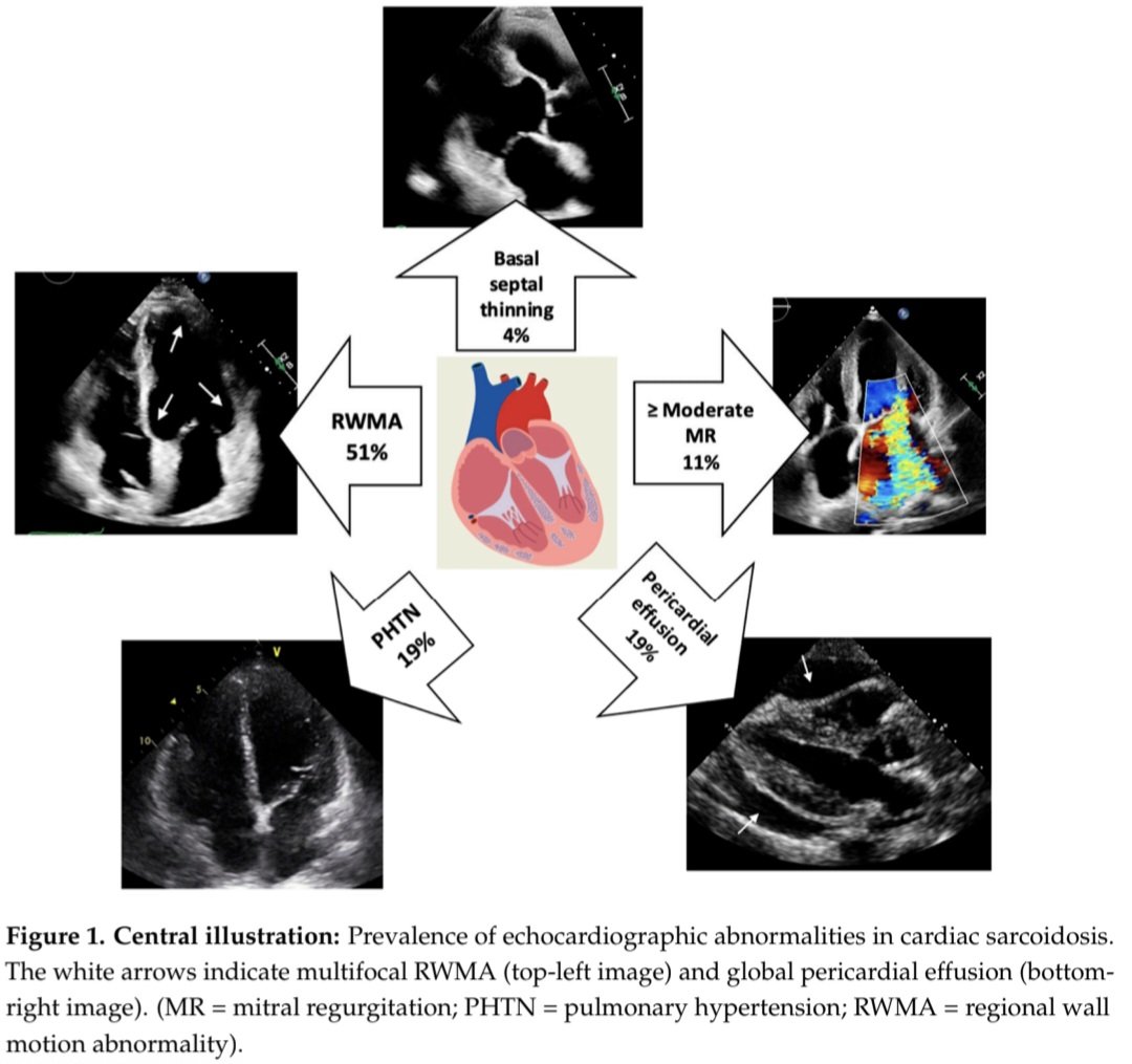 javier20ch's tweet photo. Sarcoidosis Cardíaca: ecocardiograma. 🔎🫀💢
🟦 La ecocardiografía es fundamental en su evaluación inicial, aunque con baja sensibilidad diagnóstica (S: 25–32%), pero con especificidad del 95–100%.
Hallazgos: 🧐⤵️
🔹 Alteraciones segmentarias: presentes en aproximadamente 35–50% de los pacientes al diagnóstico, frecuentemente sin respetar territorios coronarios. El adelgazamiento regional sugiere cicatriz, mientras que el engrosamiento focal y la ecogenicidad aumentada pueden relacionarse con infiltración granulomatosa o inflamación.
🔹 Adelgazamiento septal basal: uno de los hallazgos más característicos. Un grosor ≤4 mm o una relación septum basal/septum máximo ≤0.6 alcanza una especificidad del 99%.
🔹 Ventrículo derecho: puede presentar disfunción, adelgazamiento y aneurismas de pared libre, simulando una MC arritmogénica del VD. La disfunción ventricular derecha sin HP ni disfunción diastólica significativa debe aumentar la sospecha.
🔹 Strain longitudinal global: puede detectar disfunción subclínica incluso con FEVI preservada. Los estudios han propuesto puntos de corte entre −16.3% y −18% [SLG de −16.3% ➡️ S: 82%, E: 81%]. Y un Strain de pared libre del VD con punto de corte de −21.4% alcanzó sensibilidad del 86%, especificidad del 81% y AUC de 0.91 en una cohorte, lo que sugiere utilidad adicional al GLS del VI.
👨‍⚕️💬 Estos Hallazgos no establecen por sí solos el diagnóstico. Deben integrarse con la clínica, EKG, RMC y PET-FDG.

📝🆓️⤵️
https://t.co/F7S9lm0pqi
https://t.co/ypCiv50PA7