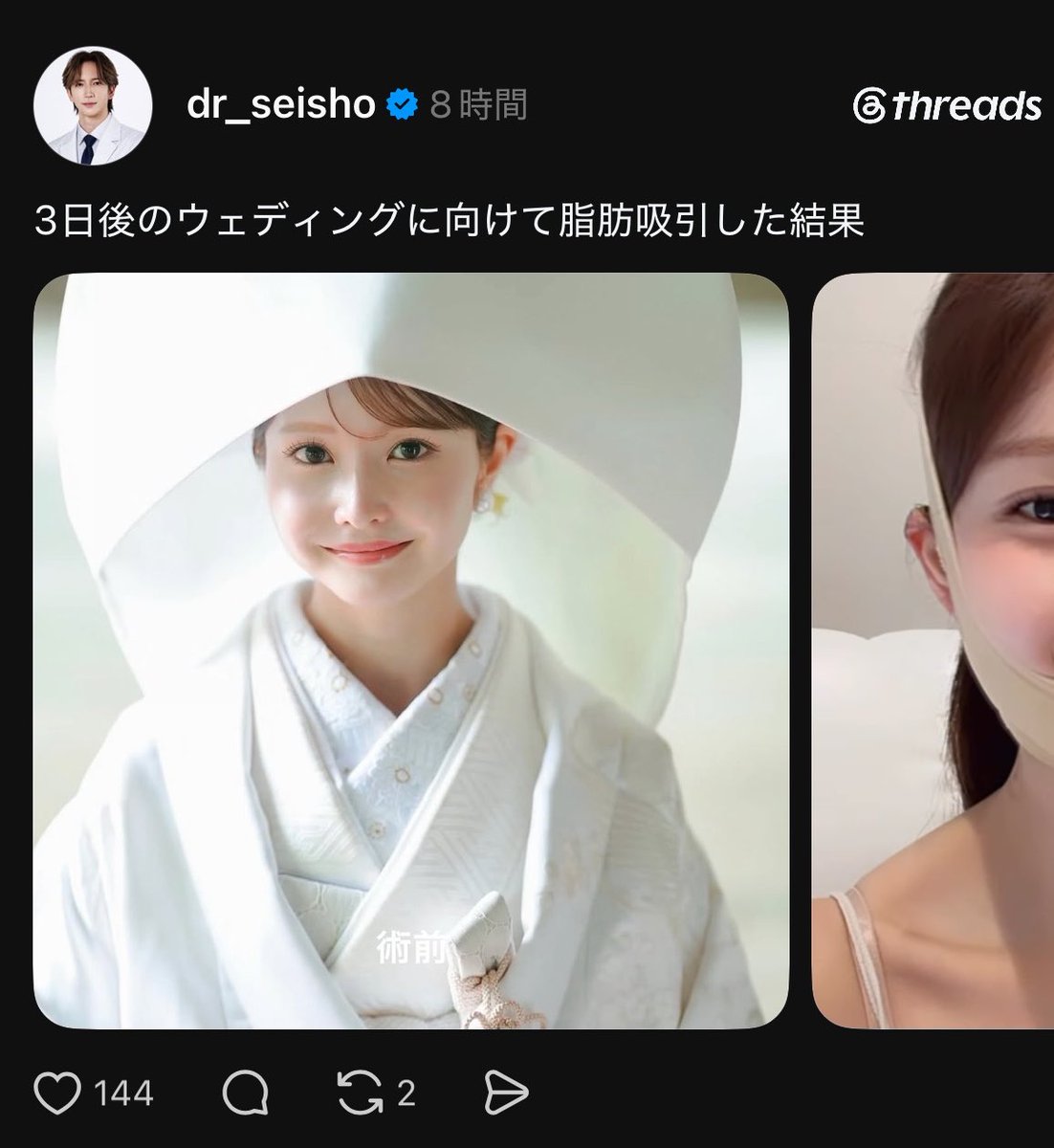 yupi0100's tweet photo. 結婚式3日前に脂肪吸引⁉️私1週間は腫れでパンパンだったけど、よくやったな.... https://t.co/jdo2wIHfSW
