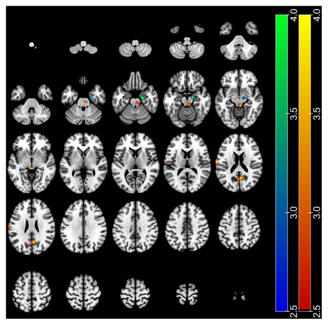 agingdoc1's tweet photo. The Effect of Daily Low Dose Tadalafil on Cerebral Perfusion and Cognition in Patients with Erectile Dysfunction and Mild Cognitive Impairment

“The results of this prospective clinical study suggest that daily use of tadalafil 5 mg increases some regional CBF and improves cognitive function in patients with ED and mild cognitive impairment.”

https://t.co/XNLwZ9jKaP