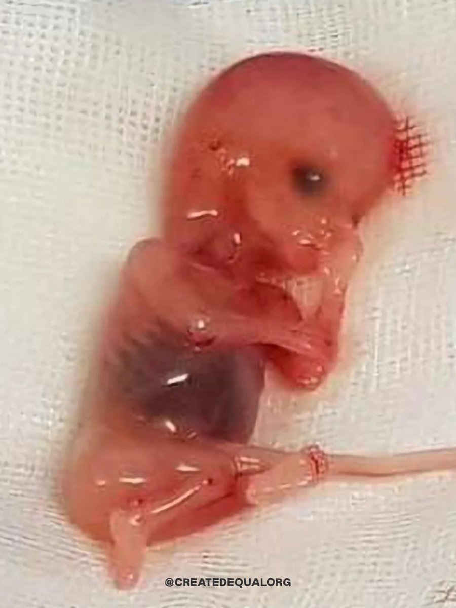 createdequalorg's tweet photo. Reminder that abortion has victims.

This baby was 9 weeks old when killed by the abortion pill. https://t.co/UzLzjjmOn4