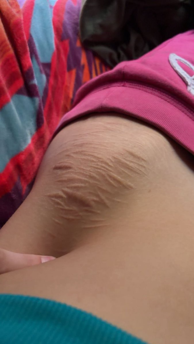 skinned_fl3sh's tweet photo. fake scars #scarspo https://t.co/Ck8XdJNgoM