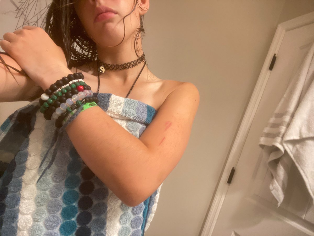 Mutilated_Lord's tweet photo. Im clean yayyy

CW for first slide: SH scars (semi fresh) https://t.co/2F0nSStj5q